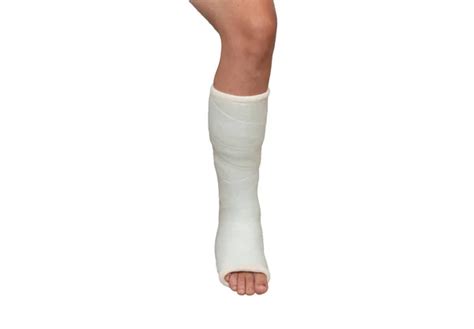 Ankle cast Stock Photos, Royalty Free Ankle cast Images | Depositphotos