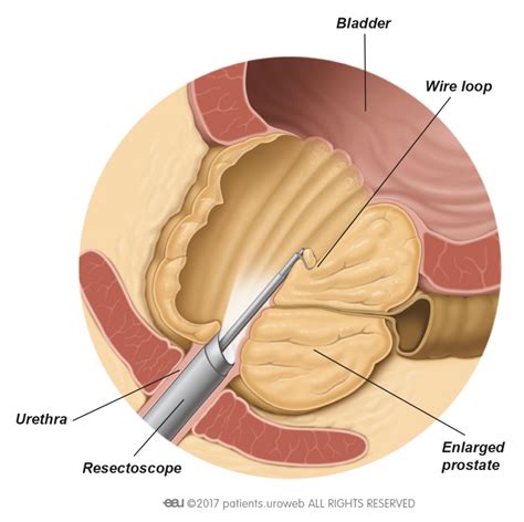 Transurethral Resection Of The Prostate