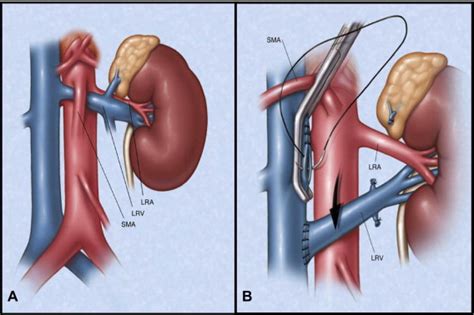 Left Renal Vein Transposition For Nutcracker Syndrome Journal Of