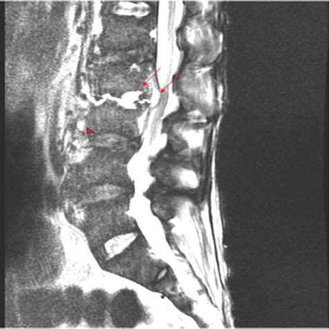 T Enhanced Mri Of The Lumbar Spine Sagittal View Demonstrating Mm