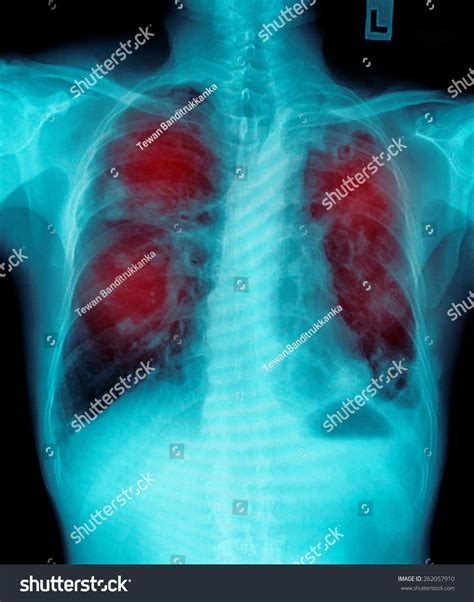 Film Chest Xray Show Alveolar Infiltrate Foto Stok Shutterstock