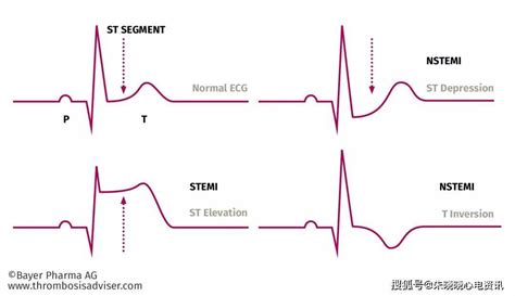ST段抬高与非ST段抬高心梗的这些区别您知道么 搜狐大视野 搜狐新闻