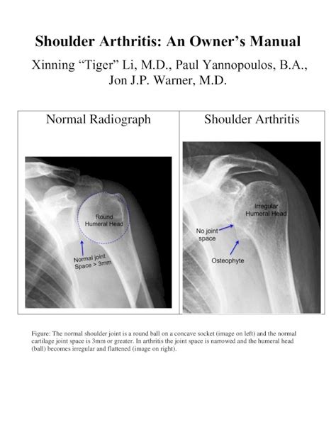 Pdf Shoulder Arthritis An Owners Manualthere Are Three Major