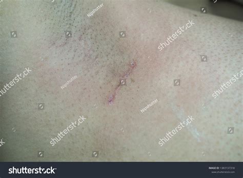 Surgical Wound Armpit Sentinel Lymph Node Stock Photo 1383137318