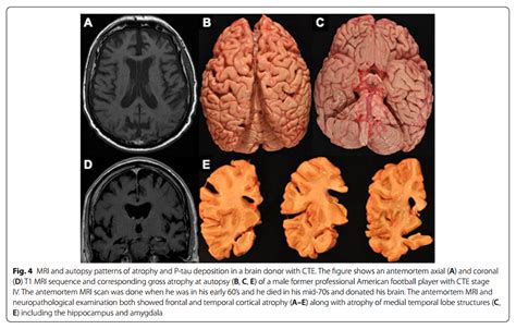 Encefalopatia Traumática Crônica – neurosky