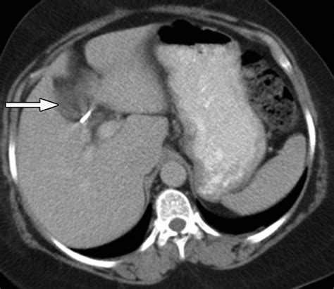 Laparoscopic Cholecystectomy Postoperative Imaging Ajr