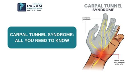 Carpal Tunnel Syndrome All You Need To Know