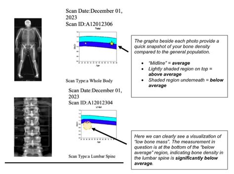 How Do I Read A Dxa Bone Density Report Mens Health Boston