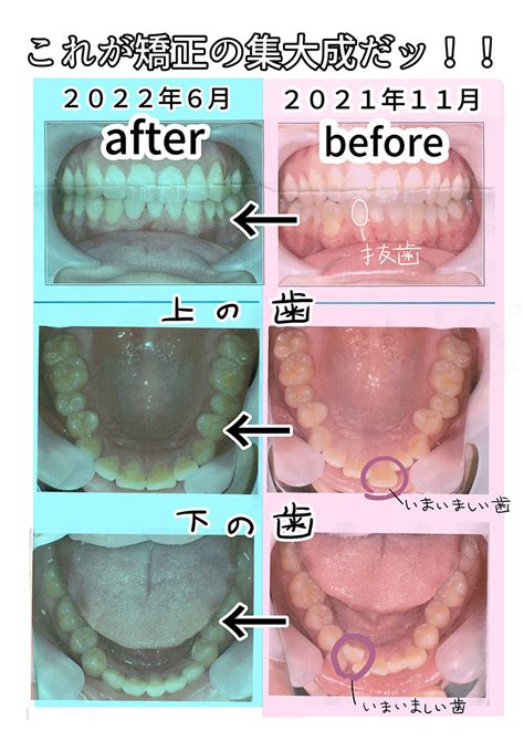 歯並びがコンプレックスだったから今のうちに矯正してみた【完結！】 イーアイデム「ジモコロ」