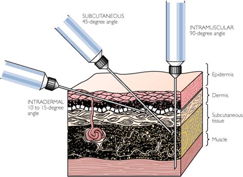 Intramuscular Injections: Z-Track Method of Intramuscular Injection