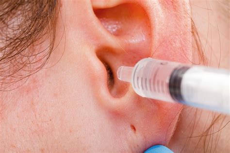 Ear Wax Removal When To See A Doctor