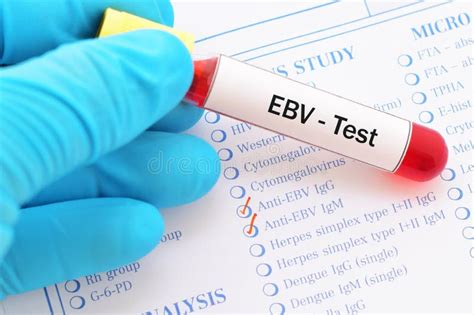 Ebv Test Stock Photo Image Of Laboratory Hematology 102159950