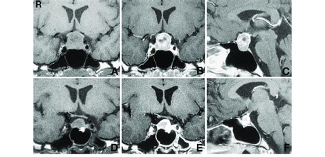 Case 5 Preoperative Coronal T 1 Weighted Magnetic Resonance MR