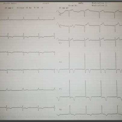 The Twelve Lead Electrocardiogram Showed Left Ventricular Hypertrophy