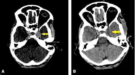 Cavernous Sinus Thrombosis A Late Complication Of Head And Neck Surgery Bmj Case Reports