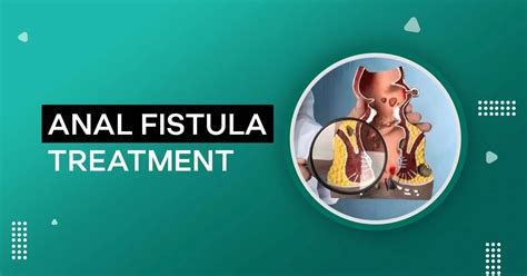 Anal Fistula Treatment Expert Advice On Surgery And Recovery Best