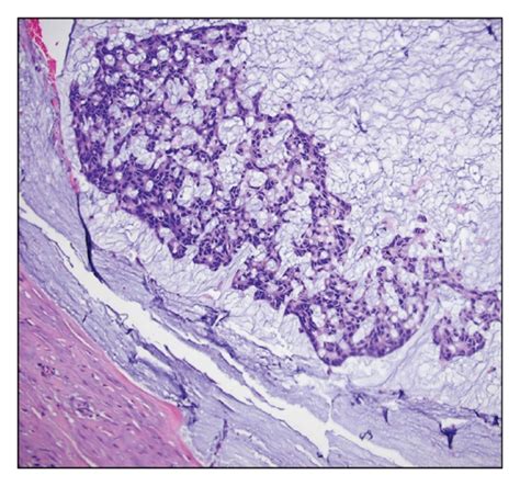 Colloid Carcinoma Or Mucinous Noncystic Carcinoma Arising From An IPMN