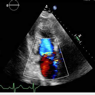 Transthoracic Echocardiogram With Two Chamber Apical View Showing