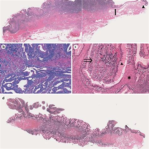 Esophagogastroduodenoscopy 2012 A Multiple Esophageal Squamous Download Scientific Diagram