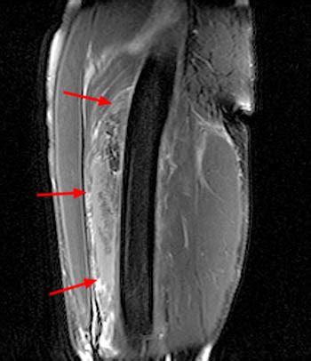 MRI of Rectus Femoris / Quadriceps Injury | Radsource