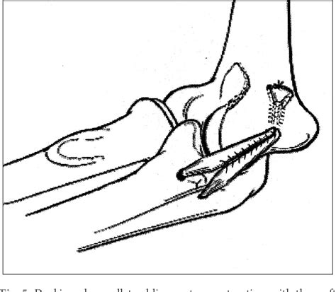 Figure 1 From Management Of Ulnar Collateral Ligament Injuries In Overhead Athletes Semantic