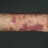 Purpura (overview) Images - Altmeyers Encyclopedia - Department Dermatology
