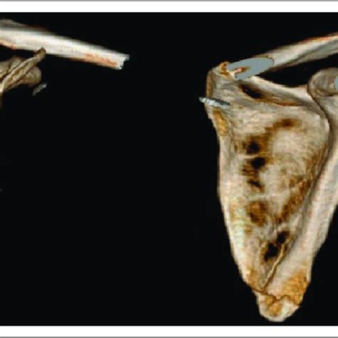 D Ct Reconstruction Of An Inferior Angle Of Scapula Fracture