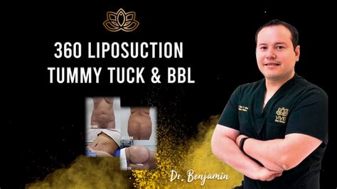 360 Liposuction Tummy Tuck And Bbl Youtube