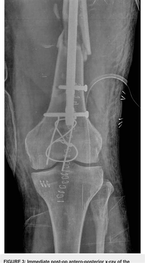 Figure 3 From Simultaneous Bilateral Intertrochanteric Fractures Of The