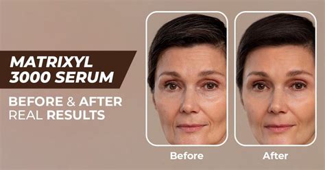 Peptídeos Matrixyl Antes E Depois - Matrixyl 3000 Serum Before and After | Skin Deva Guide 2025