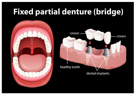 Medical Vector of Fixed Partial Denture 297841 Vector Art at Vecteezy