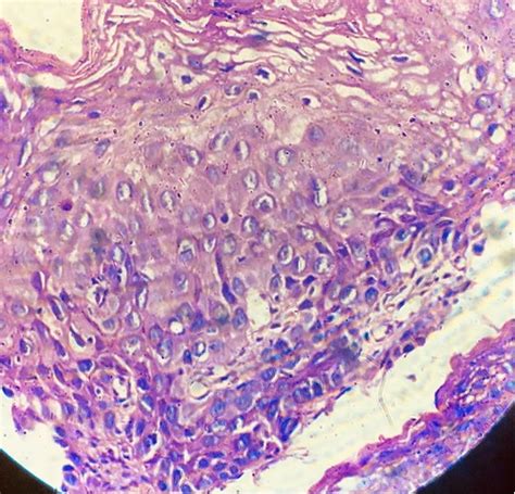 Esophageal Squamous Cell Carcinoma Histology