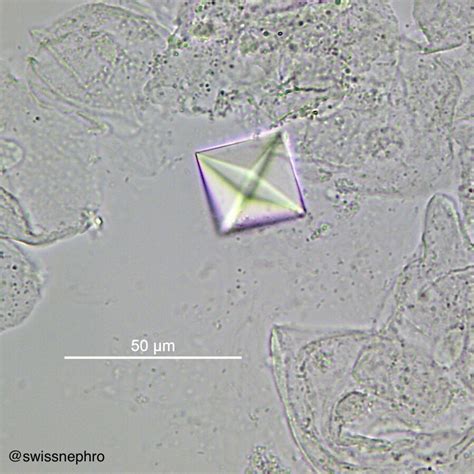 Crystals In Human Urine