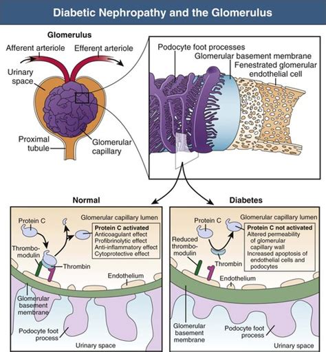 Pathogenesis Clinical Manifestations And Natural History Of Diabetic