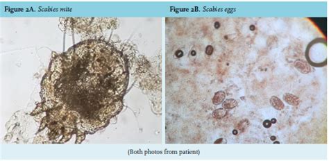 Skin Scraping For Scabies