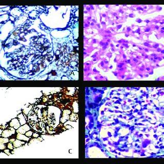 Morphological Spectrum Of Various Crescentic Glomerulonephritis Figure1