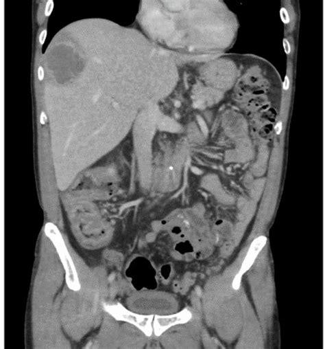 An Underestimated Sexually Transmitted Infection Amoebiasis Bmj Case Reports