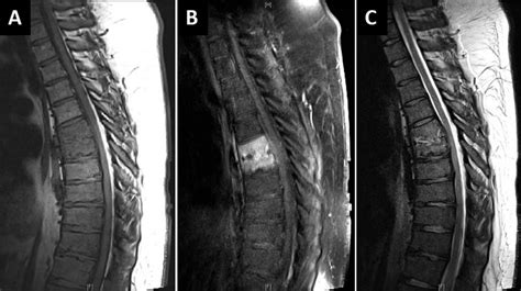 Magnetic Resonance Imaging Of The Thoracic Spine Demonstrates T