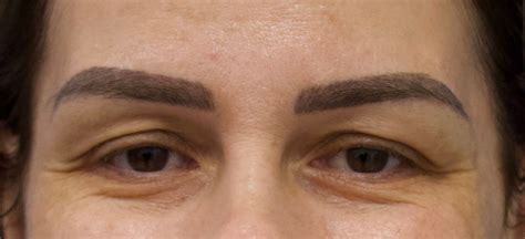 Washington Dc Blepharoplasty Upper And Lower Tysons Corner Eyelid Lift Surgery