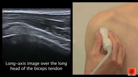 Shoulder Anatomy Ultrasound