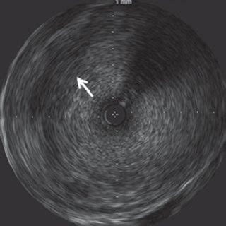 An Intravascular Ultra Sound IVUS Image Of The Aneurysm Measuring 12