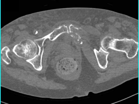 Pubic Ramus Fracture Image Images Fracture