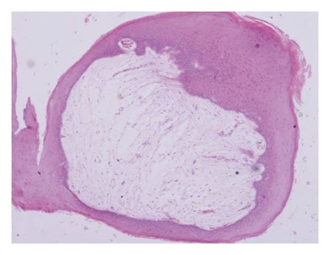 Histopathology Ac A Polypoidal Lesion Lined By Hyperplastic Download Scientific Diagram