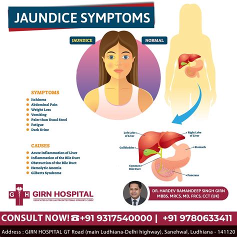 Jaundice symptoms – Artofit