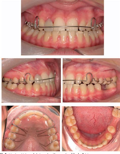 Spring Retainer Before And After