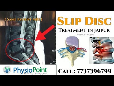 Slip Disc Herniated Disc Treatment Without Surgery In Jaipur Youtube