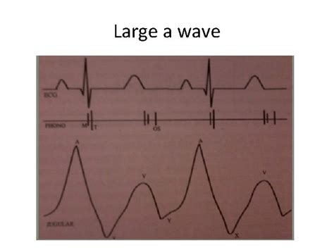 Jugular venous pressure and waveforms Dr Bijilesh Jugular