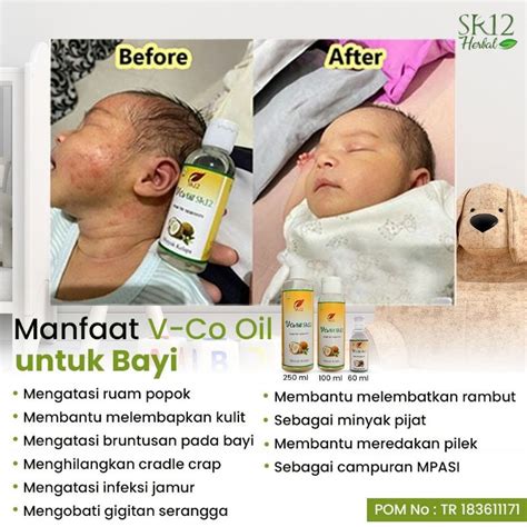 Jual Vco Bayi Obat Gatal Gatal Biang Keringat Ruam Popok Bayi