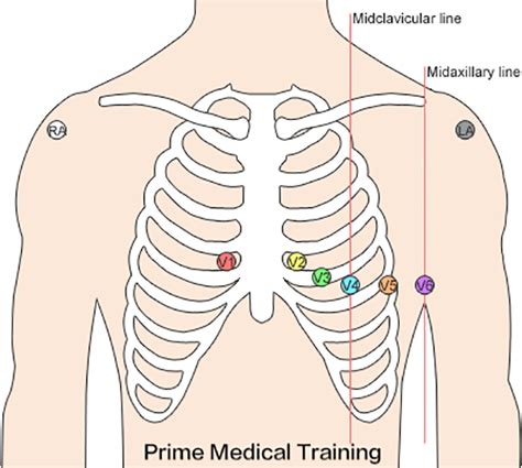 Pediatric Ecg Lead Placement Pediatric Cardiology Center Of Oregon