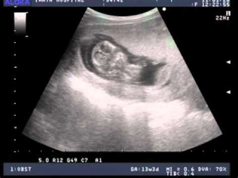 Pregnancy Ultrasound Second Month YouTube